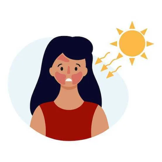 Effective Sunburn Relief